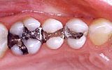 Amalgam Fillings
