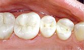 mercury-free white composite fillings
