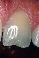 chipped tooth repaired with tooth bonding
