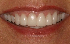 All-porcelain crowns are metal-free