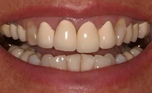 ugly porcelain-fused-to-metal crowns