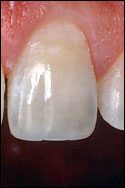 example of repair with tooth bonding