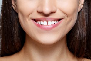 image of a woman with a gap in her front teeth